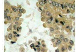 Immunohistochemistry analysis of Akt2 antibody in paraffin-embedded human lung carcinoma tissue. (AKT2 抗体)