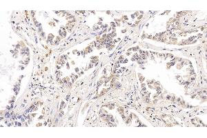 Detection of RRM1 in Human Lung cancer Tissue using Polyclonal Antibody to Ribonucleotide Reductase M1 (RRM1) (RRM1 抗体  (AA 1-213))