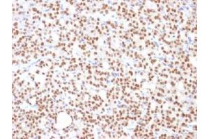 IHC testing of FFPE human thyroid carcinoma with PAX8 antibody (clone PAX8/1492). (PAX8 抗体  (AA 60-261))