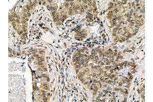 ABIN7095525 and ABIN7099582 at 1/100 staining human lung cancer and adjacent non-tumor tissue by IHC-P. (WDR77 抗体)