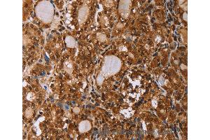 Immunohistochemistry of Human ovarian cancer using IHH Polyclonal Antibody at dilution of 1:50 (Indian Hedgehog 抗体)