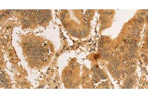 Immunohistochemistry of paraffin-embedded Human colon cancer tissue using RPL26L1 Polyclonal Antibody at dilution 1:30 (RPL26L1 抗体)