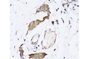 Immunohistochemistry of paraffin-embedded Human breast cancer using NAA10 Polyclonal Antibody at dilution of 1:100 (40x lens). (NAA10 抗体)