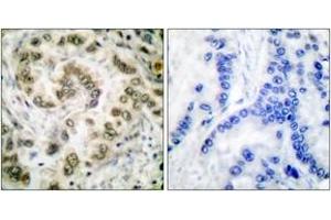 Immunohistochemistry analysis of paraffin-embedded human lung carcinoma tissue, using E2F4 Antibody. (E2F4 抗体  (AA 51-100))