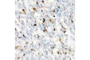 Immunohistochemistry of paraffin-embedded human esophageal cancer using CD68 antibody (ABIN5975414) at dilution of 1/100 (40x lens). (CD68 抗体)
