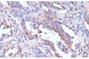 Immunohistochemistry of paraffin-embedded Human lung cancer using CARTPT Polyclonal Antibody at dilution of 1:100 (40x lens). (CARTPT 抗体)