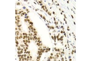 Immunohistochemistry of paraffin-embedded human breast cancer using NFKB2 Antibody. (NFKB2 抗体  (AA 690-899))