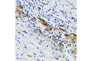 Immunohistochemistry of paraffin-embedded human liver cancer using USO1 antibody (ABIN1875291) at dilution of 1:100 (40x lens). (USO1 抗体)