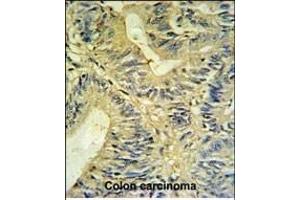 LXN Antibody (ABIN6242431 and ABIN6579060) IHC analysis in formalin fixed and paraffin embedded colon carcinoma followed by peroxidase conjugation of the secondary antibody and DAB staining. (Latexin 抗体)