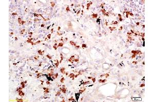 Formalin-fixed and paraffin embedded human lung carcinoma labeled with Anti-CD15/Fut4/SSEA-1 Polyclonal Antibody, Unconjugated (ABIN733193) at 1:200 followed by conjugation to the secondary antibody and DAB staining. (CD15 抗体  (AA 251-295))