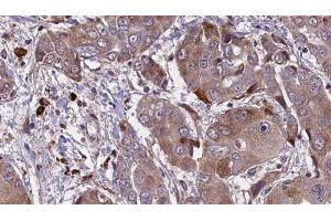 ABIN6276579 at 1/100 staining Human liver cancer tissue by IHC-P. (KCNE1 抗体  (Internal Region))