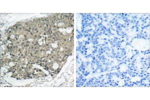 Peptide - +Immunohistochemical analysis of paraffin-embedded human breast carcinoma tissue using Akt (Ab-308) antibody (#B7005). (AKT1 抗体  (Thr308))
