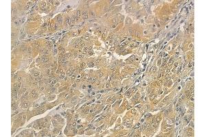 ABIN6262800 and ABIN6273259 at 1/100 staining human lung adenocarcinoma by IHC-P. (KIDINS220 抗体  (Internal Region))