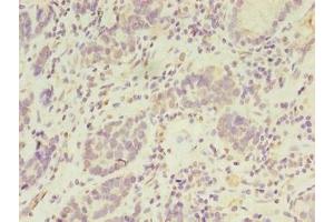 Immunohistochemistry of paraffin-embedded human gastric cancer using ABIN7169047 at dilution of 1:100 (PSKH2 抗体  (AA 63-320))