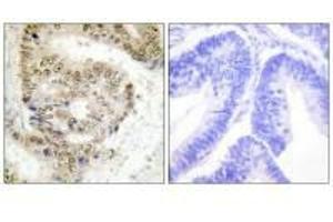 Immunohistochemistry analysis of paraffin-embedded human colon carcinoma tissue using hnRNP L antibody. (HNRNPL 抗体  (N-Term))