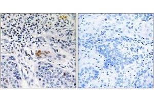 Immunohistochemistry analysis of paraffin-embedded human lung carcinoma tissue, using ZBTB40 Antibody. (ZBTB40 抗体  (AA 1121-1170))