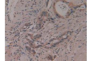 IHC-P analysis of Human Pancreas Cancer Tissue, with DAB staining. (PTGDS 抗体  (AA 32-190))