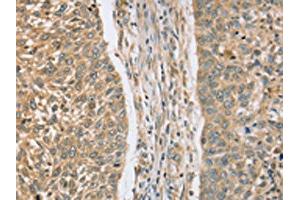 The image on the left is immunohistochemistry of paraffin-embedded Human lung cancer tissue using ABIN7130828(RASSF4 Antibody) at dilution 1/25, on the right is treated with fusion protein. (RASSF4 抗体)
