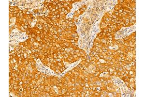 ABIN6265403 and ABIN6273018 at 1/100 staining Human lung cancer by IHC-P. (Syntaxin 11 抗体  (Internal Region))