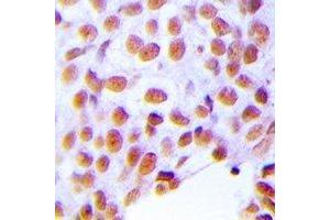 Immunohistochemical analysis of ZNF24 staining in human breast cancer formalin fixed paraffin embedded tissue section. (ZNF24 抗体  (N-Term))
