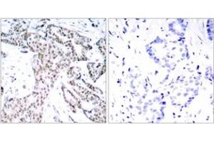 Immunohistochemistry analysis of paraffin-embedded human breast carcinoma, using STAT3 (Phospho-Ser727) Antibody. (STAT3 抗体  (pSer727))
