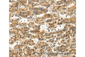 Immunohistochemistry of Human thyroid cancer using PAPPA Polyclonal Antibody at dilution of 1:50 (PAPPA 抗体)