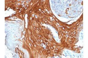 Formalin-fixed, paraffin-embedded human Basal Cell Carcinoma stained with Cytokeratin 6A (KRT6A) Mouse Monoclonal Antibody (KRT6A/2368). (KRT6A 抗体)