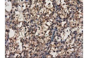Immunohistochemical staining of paraffin-embedded Carcinoma of Human kidney tissue using anti-DSTN mouse monoclonal antibody. (Destrin 抗体)
