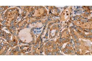 Immunohistochemistry of paraffin-embedded Human thyroid cancer using PLS3 Polyclonal Antibody at dilution of 1:30 (Plastin 3 抗体)