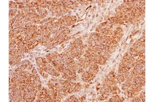 IHC-P Image Immunohistochemical analysis of paraffin-embedded DLD1 xenograft, using ACADM, antibody at 1:100 dilution. (Medium-Chain Specific Acyl-CoA Dehydrogenase, Mitochondrial (N-Term) 抗体)