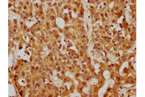 IHC image of ABIN7169288 diluted at 1:200 and staining in paraffin-embedded human liver cancer performed on a Leica BondTM system. (PP5 抗体  (AA 370-488))