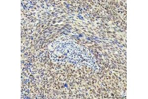 IHC analysis of DDX1 using anti-DDX1 antibody (ABIN7602052). (DDX1 抗体  (AA 562-740))