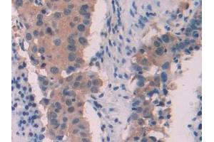 DAB staining on IHC-P; Samples: Human Lung cancer Tissue