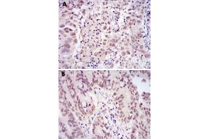 Immunohistochemical analysis of paraffin-embedded human endometrial cancer tissue (A) and rectum cancer tissue (B) using CDK9 monoclonal antibody, clone 1B5D10  with DAB staining. (CDK9 抗体)