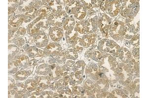 ABIN6255618 and ABIN6267141 at 1/100 staining human renal cell carcinoma by IHC-P. (MST1 抗体  (pThr183))