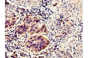 Immunohistochemistry of paraffin-embedded human bladder cancer using ABIN7155869 at dilution of 1:100 (HIPK3 抗体  (AA 841-1130))