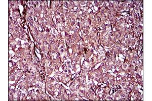 Immunohistochemical analysis of paraffin-embedded liver cancer tissues using MCAM mouse mAb with DAB staining. (MCAM 抗体  (AA 84-189))