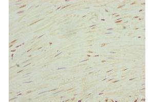 Immunohistochemistry of paraffin-embedded human colon cancer using ABIN7168034 at dilution of 1:100 (RhoF 抗体  (AA 1-170))