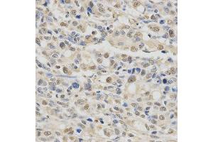Immunohistochemistry of paraffin-embedded human stomach cancer using SPHK1 antibody at dilution of 1:200 (x400 lens). (SPHK1 抗体  (AA 50-384))