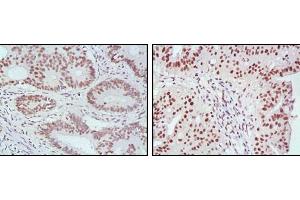 Immunohistochemical analysis of paraffin-embedded human rectum cancer (left) and ovarian cancer (right) tissues, showing nuclear localization with DAB staining using MLH1 mouse mAb. (MLH1 抗体  (AA 381-483))