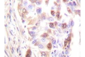 Immunohistochemistry analyzes of RFA2 antibody in paraffin-embedded human lung carcinoma tissue. (RPA2 抗体  (AA 115-129))