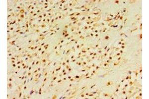 Immunohistochemistry of paraffin-embedded human breast cancer using ABIN7150785 at dilution of 1:100 (DUSP7 抗体  (AA 160-419))