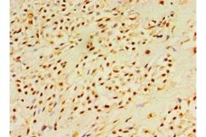 Immunohistochemistry of paraffin-embedded human breast cancer using ABIN7150785 at dilution of 1:100 (DUSP7 抗体  (AA 160-419))