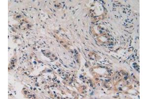 IHC-P analysis of Human Pancreas Cancer Tissue, with DAB staining. (SLIT2 抗体  (AA 1416-1528))