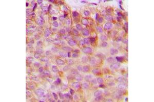 Immunohistochemical analysis of 14-3-3 eta staining in human breast cancer formalin fixed paraffin embedded tissue section. (14-3-3 eta 抗体  (Center))