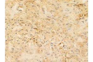 ABIN6255637 and ABIN6267229 at 1/100 staining human renal cell carcinoma by IHC-P.