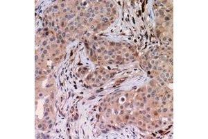 Immunohistochemical analysis of USP6NL staining in human breast cancer formalin fixed paraffin embedded tissue section. (USP6NL 抗体)