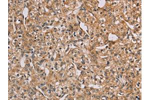 The image on the left is immunohistochemistry of paraffin-embedded Human prostate cancer tissue using ABIN7128941(CHRNA4 Antibody) at dilution 1/20, on the right is treated with fusion protein. (CHRNA4 抗体)