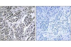 Immunohistochemistry analysis of paraffin-embedded human lung carcinoma tissue, using ATP5D Antibody. (ATP5F1D 抗体  (AA 61-110))
