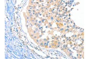 The image on the left is immunohistochemistry of paraffin-embedded Human breast cancer tissue using ABIN7129275(DUSP14 Antibody) at dilution 1/20, on the right is treated with fusion protein. (DUSP14 抗体)